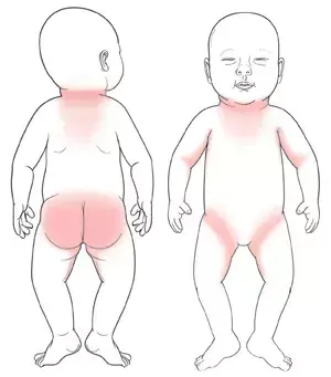 宝宝起热疹子怎么办，月子里宝宝起了热疹子怎么回事（高温来袭，宝宝长了痱子怎么办）