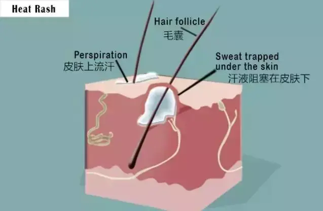 宝宝起热疹子怎么办，月子里宝宝起了热疹子怎么回事（高温来袭，宝宝长了痱子怎么办）