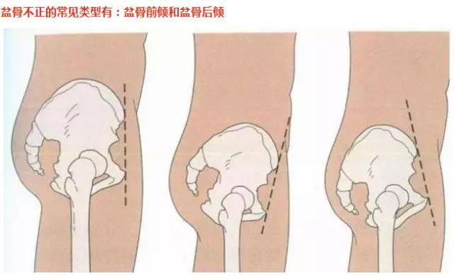 骨盆前倾1到10度图片，骨盆前倾严重的效果图（常常听到的骨盆前倾后倾）