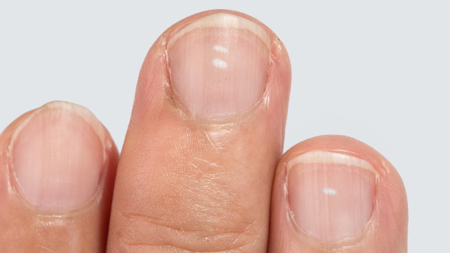 指甲的变化意味着身体的健康状况(指甲出现这些变化) 