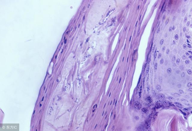 毛囊炎是什么样子的图片，粉刺是什么样子图片（毛囊炎的表现症状有哪些）