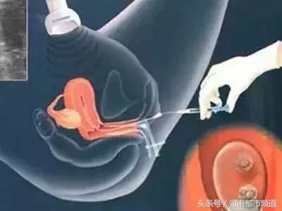 女性卖卵有什么危害，女孩子如何远离卖卵风潮（湖北少女为做这件傻事去卖卵）