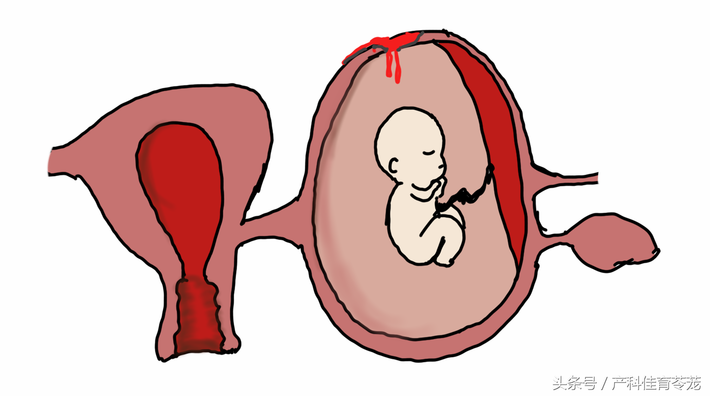 单角子宫怎么治疗(异位妊娠之残角子宫妊娠) - seo葵花宝典