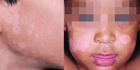 白斑有几种图片，各种白斑介绍（是不是肚子里有蛔虫）