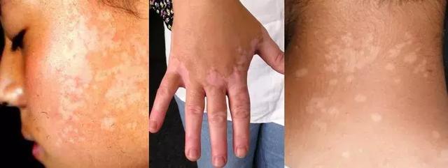 白斑有几种图片，各种白斑介绍（是不是肚子里有蛔虫）