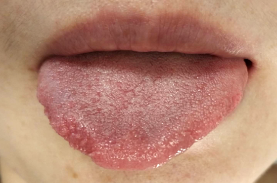 女人舌头发麻的10大疾病征兆 灼口综合症有哪些症状 