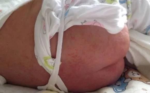 小孩皮肤病的种类图片，儿童皮肤病图片（这12种宝宝常见皮肤病危害不比湿疹小）