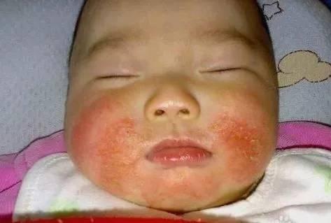小孩皮肤病的种类图片，儿童皮肤病图片（这12种宝宝常见皮肤病危害不比湿疹小）