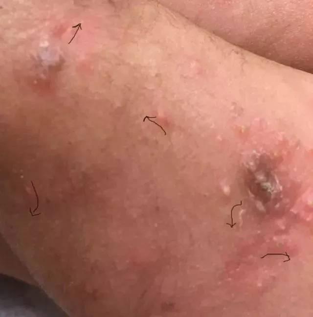 小孩皮肤病的种类图片，儿童皮肤病图片（这12种宝宝常见皮肤病危害不比湿疹小）