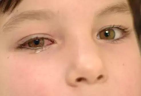 儿童突然眼屎特别多，宝宝眼睛红、眼屎多