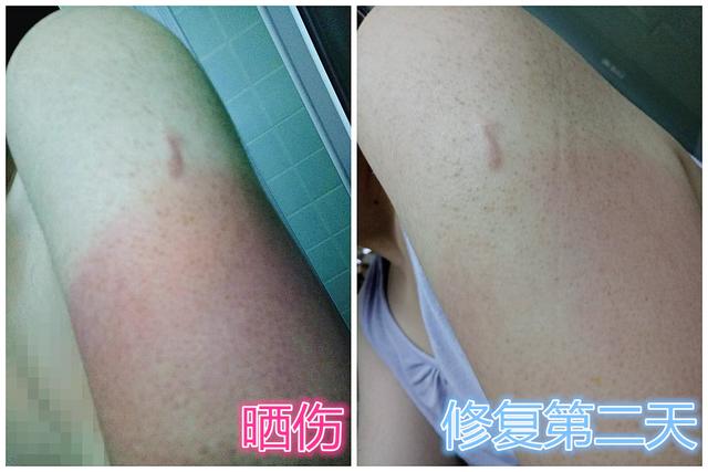 皮肤晒伤了怎么办，晒伤急救<内含真实对比图片>（太阳晒后皮肤红疼怎么办）