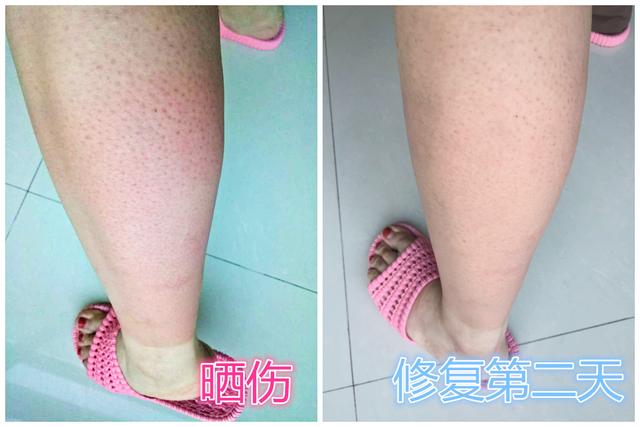 皮肤晒伤了怎么办，晒伤急救<内含真实对比图片>（太阳晒后皮肤红疼怎么办）