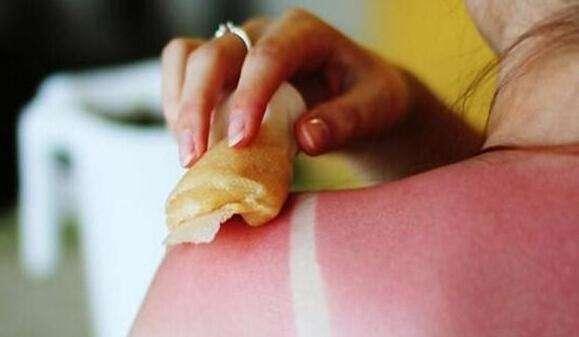 皮肤晒伤了怎么办，晒伤急救<内含真实对比图片>（太阳晒后皮肤红疼怎么办）