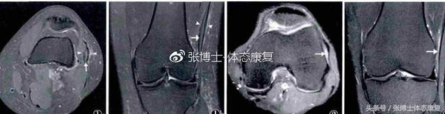 骑自行车膝盖疼怎么回事，骑自行车造成膝关节肌肉酸痛的原因是什么（你可能得了髂胫束摩擦综合征）
