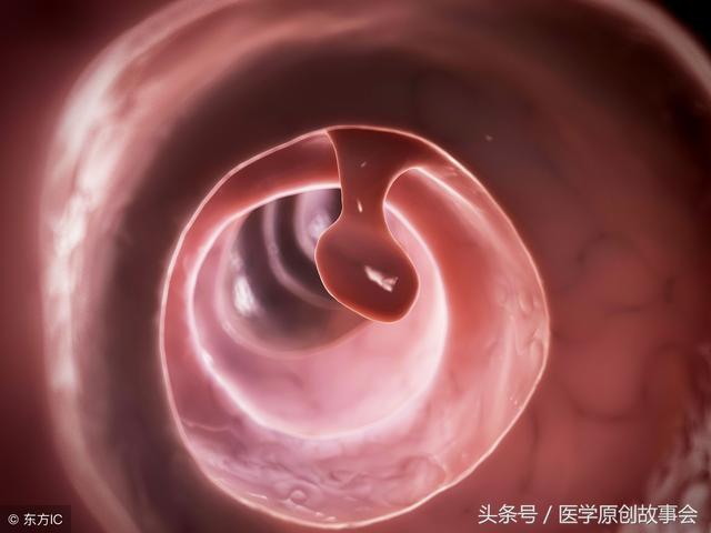 突然长黑色肉痣是什么原因，皮肤上这种痣十有八九是黑斑息肉