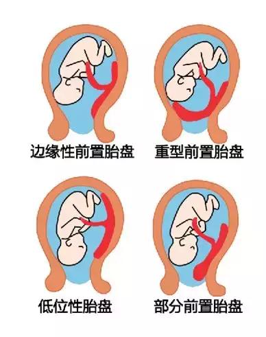 胎位roa是什么意思，产检胎位roa是什么意思（产检单上这3个指标最关键）