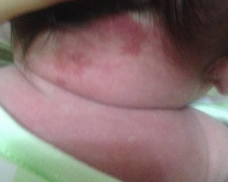 宝宝胎记和黑痣的区别，嘟嘟妈教你快速识别宝宝身上的鹤吻痕、胎记、胎痣、血管瘤哦