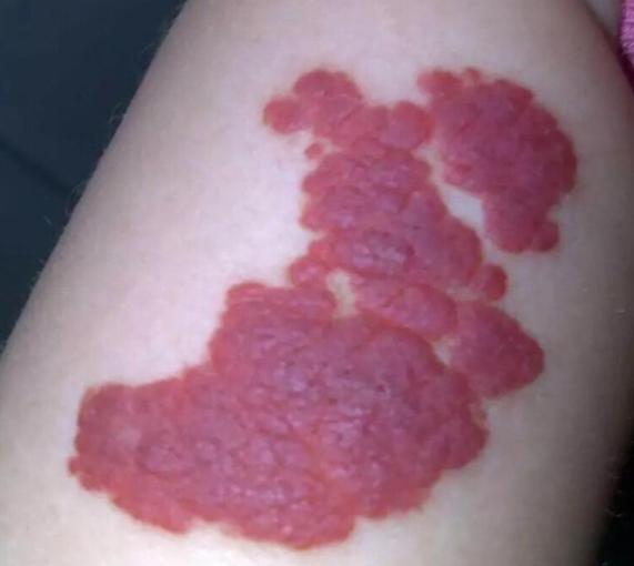 宝宝胎记和黑痣的区别，嘟嘟妈教你快速识别宝宝身上的鹤吻痕、胎记、胎痣、血管瘤哦