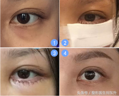 泪沟与眼袋的区别图，卧蚕眼袋和泪沟区别图解（到底“袋”走了什么）