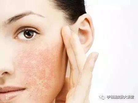 什么是敏感肌皮肤的特征，什么样的皮肤属于敏感肌（敏感性肌肤？过来集合了）