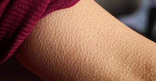 为什么会长鸡皮，女生为什么会长鸡皮疙瘩（鸡皮疙瘩随音乐而起？别害怕）