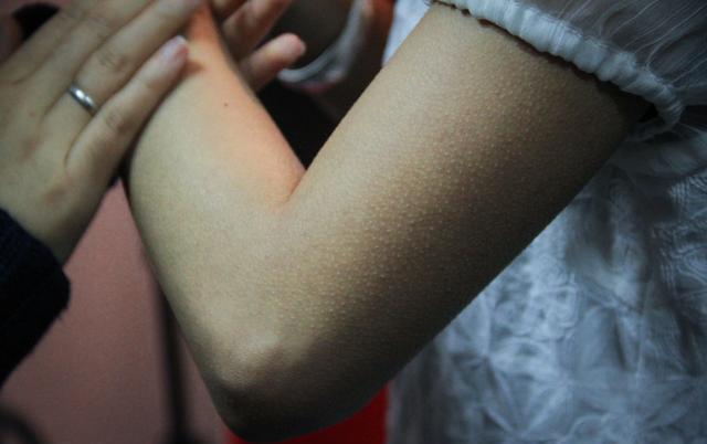 为什么会长鸡皮，女生为什么会长鸡皮疙瘩（鸡皮疙瘩随音乐而起？别害怕）