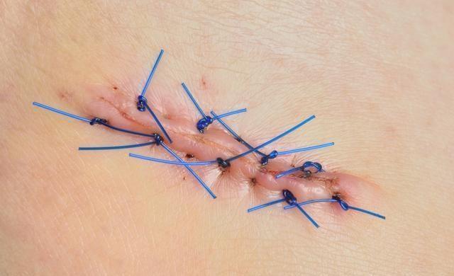 切口不愈合怎么办?) - 生活百科 - 郯城号