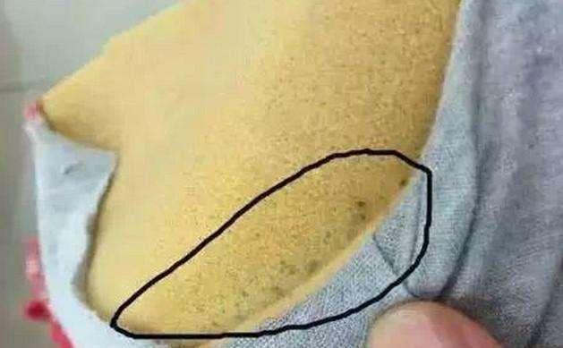 内衣过敏症状图片,穿内衣的地方起疙瘩(闺蜜买来新内衣送给女子)