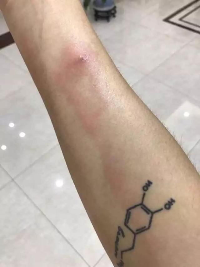 虫子咬了后红肿并且还蔓延，被虫子咬了红肿很痒蔓延（小伙被虫子咬一口手臂一路红肿）