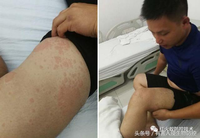 火蚁咬伤红肿怎么办，红火蚁咬伤后如何消肿（正确的处理方法是这样）