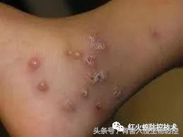 火蚁咬伤红肿怎么办，红火蚁咬伤后如何消肿（正确的处理方法是这样）