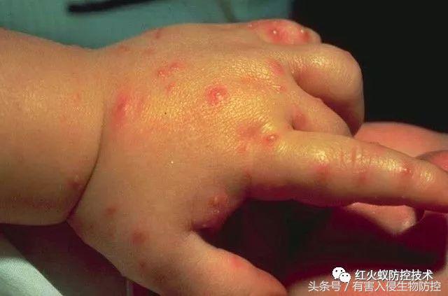 火蚁咬伤红肿怎么办，红火蚁咬伤后如何消肿（正确的处理方法是这样）
