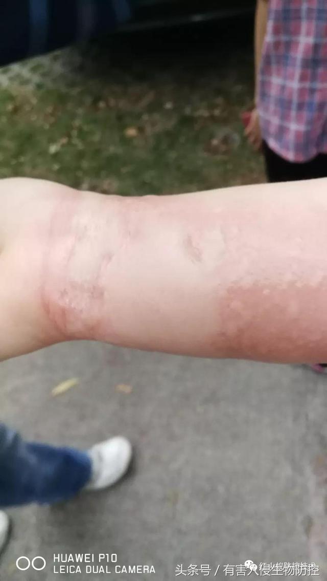 火蚁咬伤红肿怎么办，红火蚁咬伤后如何消肿（正确的处理方法是这样）
