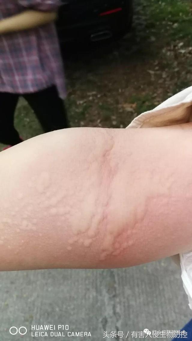 火蚁咬伤红肿怎么办，红火蚁咬伤后如何消肿（正确的处理方法是这样）