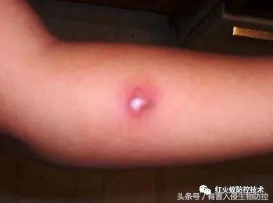 火蚁咬伤红肿怎么办，红火蚁咬伤后如何消肿（正确的处理方法是这样）