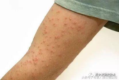 火蚁咬伤红肿怎么办，红火蚁咬伤后如何消肿（正确的处理方法是这样）