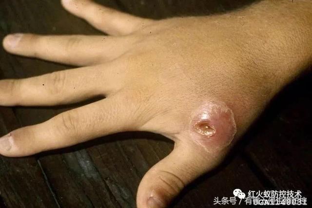 火蚁咬伤红肿怎么办，红火蚁咬伤后如何消肿（正确的处理方法是这样）
