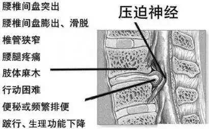 腰突脚麻恢复方法，腰突术后脚麻怎么治疗（脚麻脚痛不都是腰椎间盘突出）