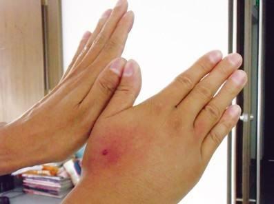 被黄蜂蛰了怎么办，孕妇被黄蜂蛰了怎么办（最正确的做法是什么）