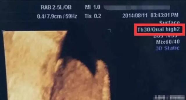 四维彩超怎么看男女，四维彩超怎么分辨男女（B超只要看一个数字就能知道胎宝性别）