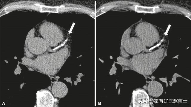 脉搏波传导速度，什么叫做脉搏波速度PWV（“血管老化”的五大常见征象）