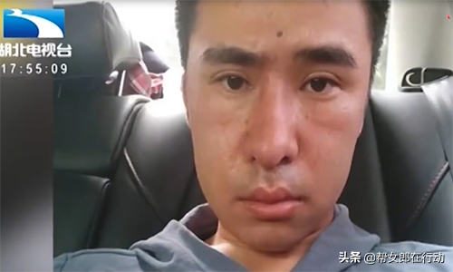 鼻部整容多少钱，整鼻多少钱（小伙花4万整容成鼻畸形）