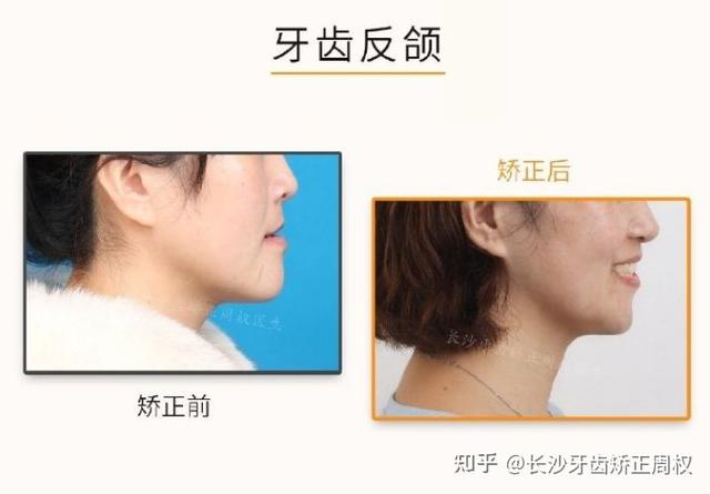 前牙反合是因什么导致的呢，前牙反合的病因（什么是反颌<地包天>）