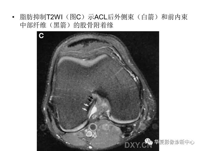 膝关节解剖结构图，膝盖解剖图示意图（膝关节MRI之正常解剖综述）