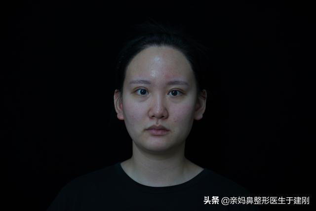 一张图看懂鼻基底凹陷对比图，塌鼻秒变立体质感鼻