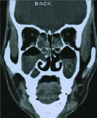 鼻窦炎微创手术，鼻窦炎微创手术价格是多少（诊治及【合理用药）