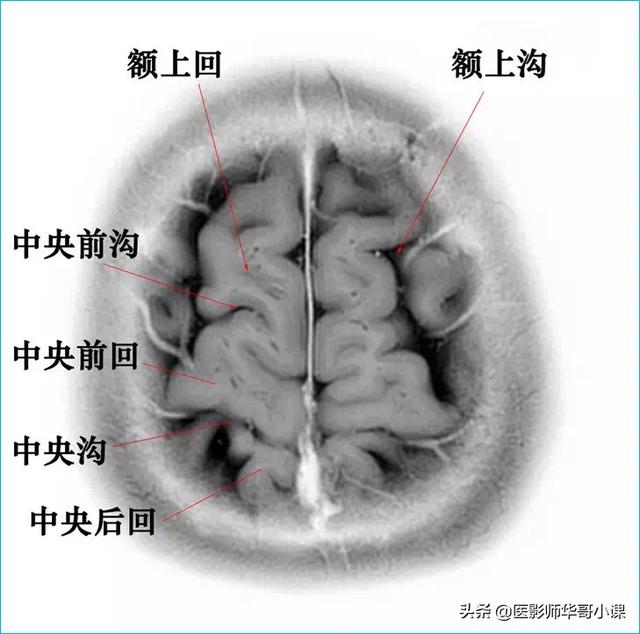 头颅ct解剖图，头部骨骼结构图（颅脑磁共振MRI解剖结构以及高清图谱）