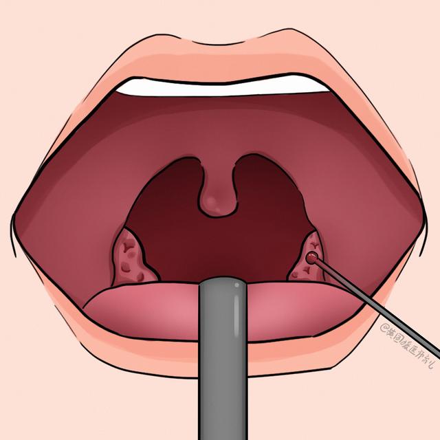 儿童腺样体肥大几岁能做手术，腺样体肥大几岁手术好（孩子腺样体、扁桃体肥大）