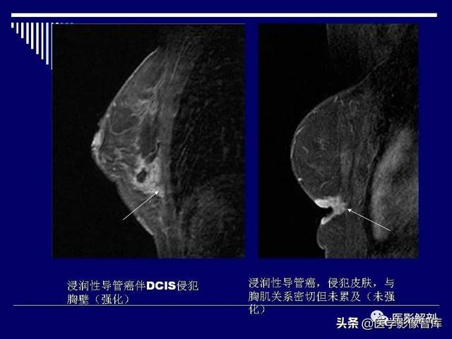 乳房解剖学基础知识，乳腺解剖及乳腺各病变影像诊断与鉴别