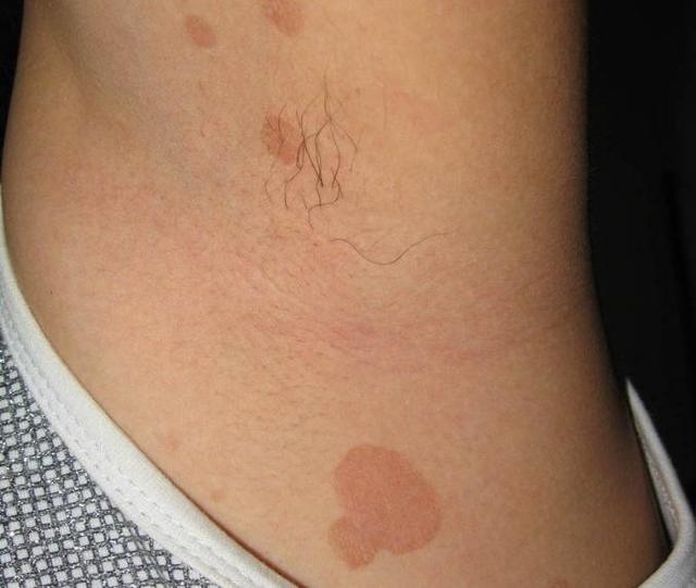 背部出现红色斑块图片，后背皮肤病种类（夏天腋下、肩背部长褐色或白色的斑疹）